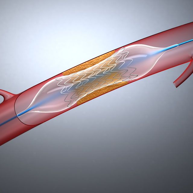 Stents cardíacos (Stent)