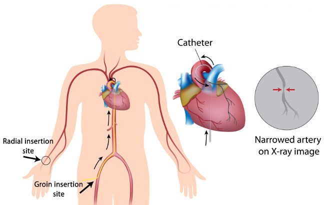 inserción radial e inserción inguinal