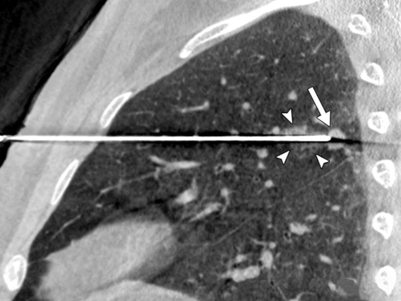 Biopsia Pulmonar Percutánea