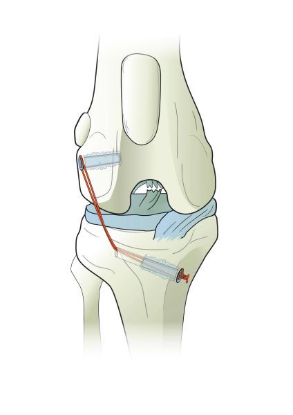   Anclajes de rosca completa Ti-Force utilizados en la reparación de ligamentos articulares.