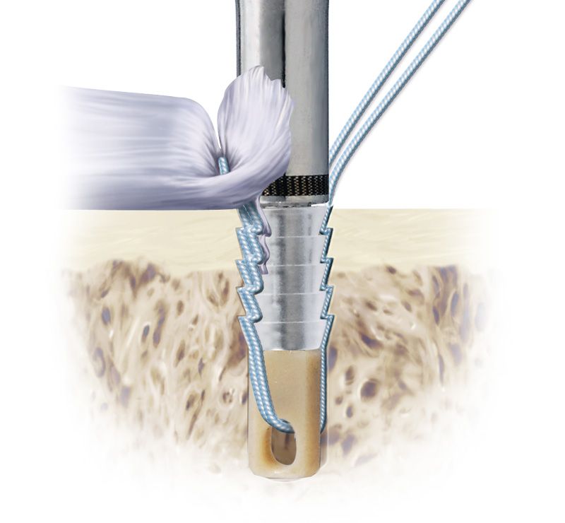 Anclaje Bio-Force Soft en escenarios quirúrgicos