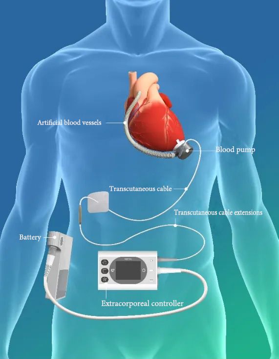 Esquema del Producto del Sistema de Asistencia Ventricular Izquierda BrioVAD™