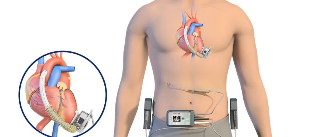 Sistema de Asistencia Ventricular Izquierda Implantable CH® (CH-VAD)